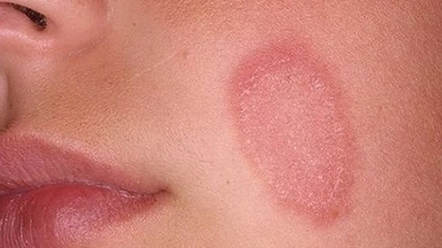 bai-viet/benh-hac-lao-co-bi-o-mat-khong-phuong-phap-chua-hac-lao-tai-nha-55471.html