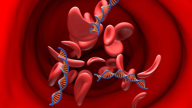 bai-viet/benh-hong-cau-hinh-liem-nguyen-nhan-trieu-chung-va-cach-nhan-biet-som.html