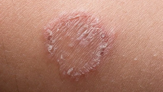 bai-viet/benh-lac-dong-tien-co-lay-khong-cach-phong-ngua-hieu-qua-72812.html