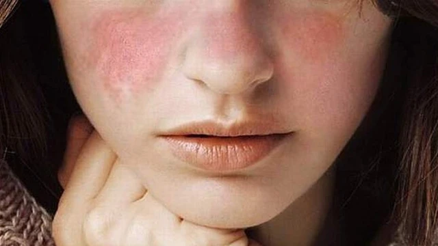 bai-viet/benh-lupus-ban-do-co-chua-duoc-khong-55767.html