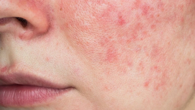 bai-viet/benh-lupus-ban-do-viem-cau-than-la-gi-va-cach-dieu-tri-57692.html