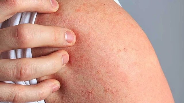 bai-viet/benh-me-day-man-tinh-vo-can-dau-hieu-va-nguyen-nhan-mac-benh-54760.html