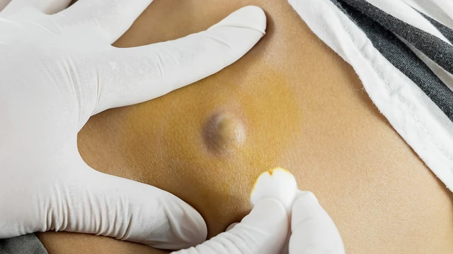 bai-viet/benh-nhan-mo-u-ba-dau-co-duoc-bao-hiem-khong.html