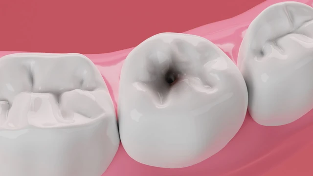 bai-viet/benh-nhan-rang-cua-bi-sau-co-tram-duoc-khong.html