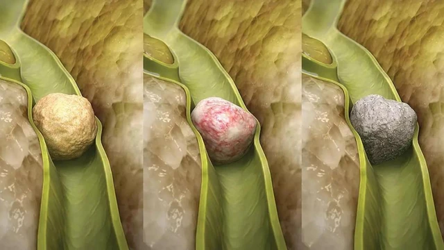 bai-viet/benh-omc-la-gi-va-nguyen-nhan-dau-hieu-cach-phong-ngua.html