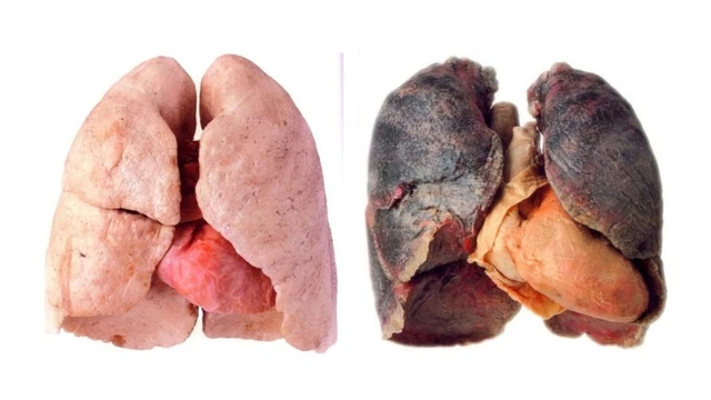 bai-viet/benh-phoi-den-nguyen-nhan-trieu-chung-va-cach-dieu-tri.html