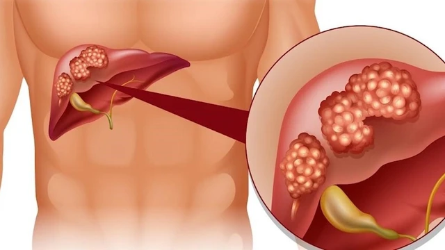 bai-viet/benh-san-la-gan-o-nguoi-co-nguy-hiem-khong.html