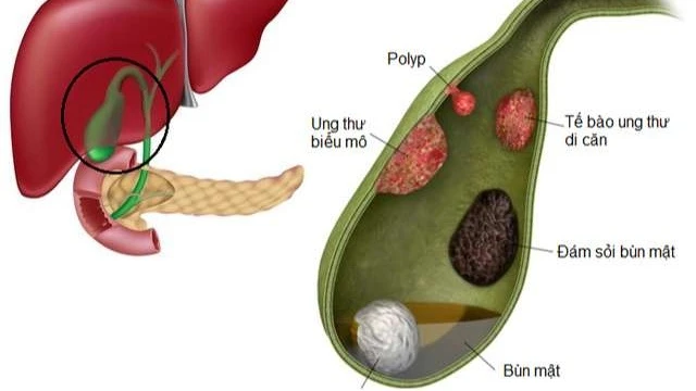 bai-viet/benh-soi-mat-bun-la-gi-nguyen-nhan-bieu-hien-va-cach-chua-tri-53614.html
