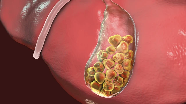 bai-viet/benh-soi-tui-mat-co-nguy-hiem-khong-phong-ngua-the-nao.html