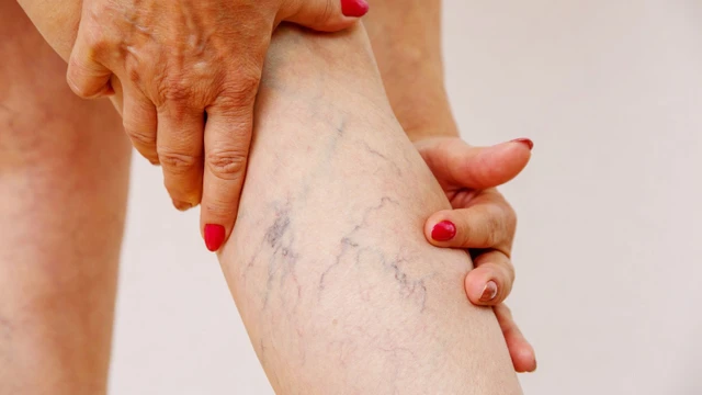 bai-viet/benh-suy-gian-tinh-mach-co-nguy-hiem-khong.html