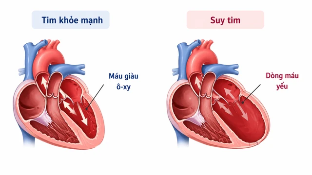 bai-viet/benh-suy-tim-co-nguy-hiem-khong-muc-do-va-bien-chung-can-biet.html