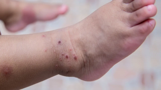 bai-viet/benh-tay-chan-mieng-tre-em-co-nguy-hiem-khong-va-cach-phong-ngua.html