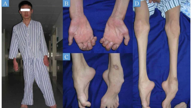 bai-viet/benh-teo-co-mac-nguyen-nhan-trieu-chung-va-cach-dieu-tri.html