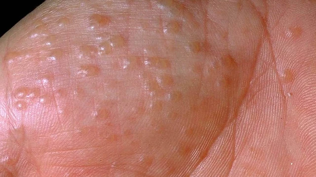 bai-viet/benh-to-dia-giai-doan-dau-nguyen-nhan-dau-hieu-va-phong-ngua-55324.html