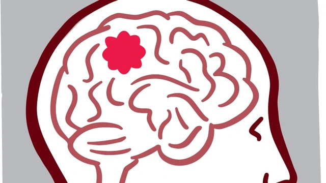 bai-viet/benh-u-nao-co-chua-duoc-khong-cach-dieu-tri-u-nao.html