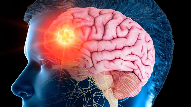 bai-viet/benh-u-nao-song-duoc-bao-lau-lam-the-nao-de-keo-dai-tuoi-tho-cho-benh-nhan-u-nao.html