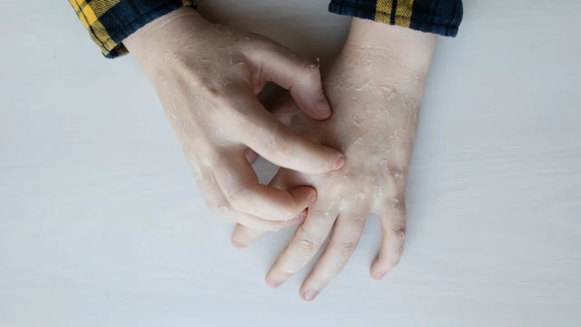 bai-viet/benh-vay-ca-harlequin-nguyen-nhan-bieu-hien-va-cach-dieu-tri.html