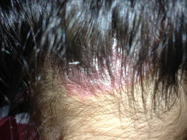 bai-viet/benh-vay-nen-da-dau-co-lay-khong-luu-y-nguoi-benh-can-nho-33450.html