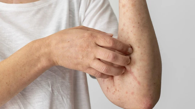 bai-viet/benh-viem-mao-mach-di-ung-anh-huong-nhu-the-nao-den-suc-khoe.html