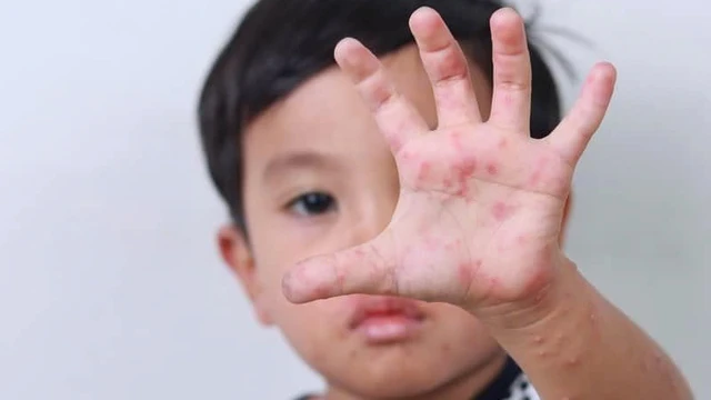 bai-viet/bi-chan-tay-mieng-co-an-duoc-thit-ga-khong-va-nhung-dieu-can-biet.html