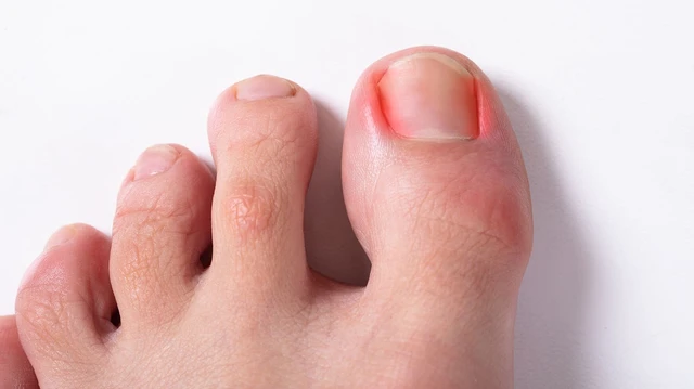 bai-viet/bi-chin-me-bao-lau-thi-khoi-cach-chua-chin-me-cuc-don-gian-tai-nha-69465.html