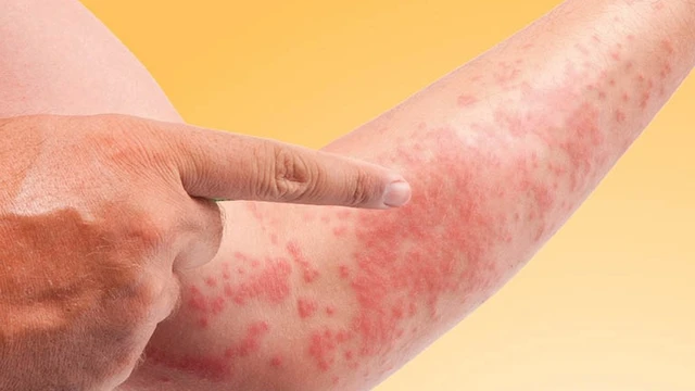 bai-viet/bi-di-ung-thoi-tiet-phai-lam-sao-huong-dan-chi-tiet-de-kiem-soat-tinh-trang-kho-chiu.html