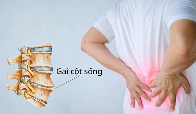 bai-viet/bi-gai-cot-song-co-nen-nam-nem-khong-cach-chon-mua-nem-ho-tro-tot-cho-lung.html
