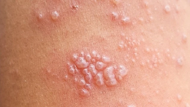 bai-viet/bi-gioi-leo-kieng-an-gi-de-nhanh-het-benh.html