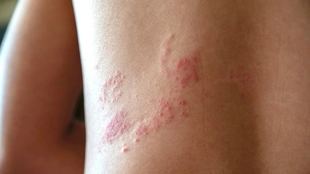 bai-viet/bi-gioi-leo-kieng-gi-an-gi-de-nhanh-khoi-benh.html