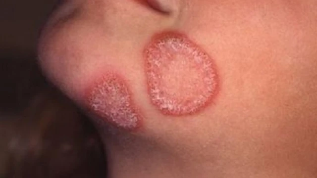 bai-viet/bi-hac-lao-an-vao-mau-dieu-tri-nhu-the-nao-54042.html