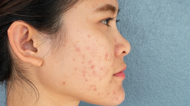 bai-viet/bi-mun-2-ben-ma-nguyen-nhan-va-cach-tri-dut-diem-nhanh.html