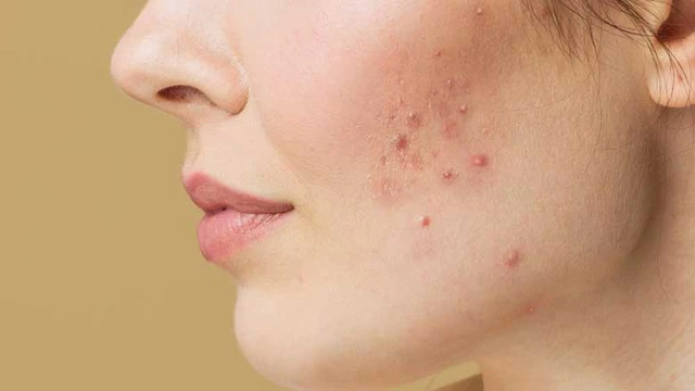 bai-viet/bi-mun-thoi-ky-man-kinh-la-nhu-the-nao-do-nguyen-nhan-nao.html