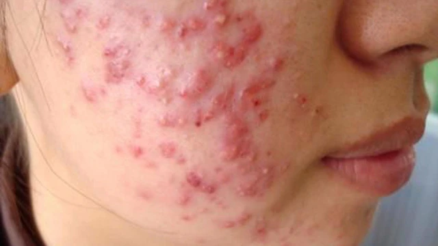 bai-viet/giai-dap-bi-mun-trung-ca-co-nen-dung-sua-rua-mat-hay-khong.html