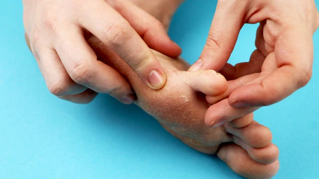 bai-viet/bi-nam-da-co-nen-rua-nuoc-muoi-khong-can-luu-y-gi-khi-tri-nam-da-bang-nuoc-muoi.html