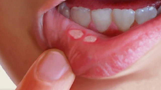 bai-viet/bi-nhiet-mieng-nen-lam-gi-de-mau-khoi-nhanh.html