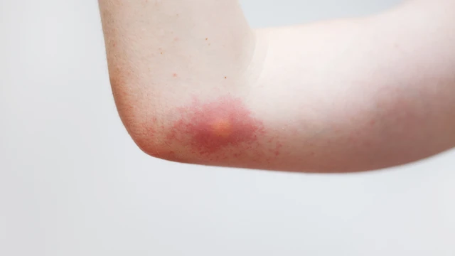 bai-viet/bi-ong-dot-boi-gi-cho-nhanh-khoi-cach-xu-ly-nhanh-chong-va-an-toan.html