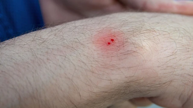 bai-viet/bi-ran-can-chan-nhung-dieu-nen-va-khong-nen-lam.html