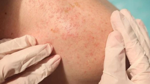 bai-viet/bi-rom-say-o-nguoi-lon-nguyen-nhan-va-cach-dieu-tri.html