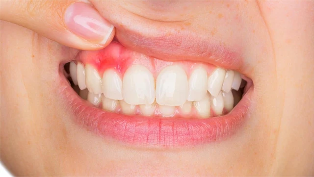 bai-viet/bi-sung-loi-phai-lam-sao-nguyen-nhan-va-dau-hieu-cua-chung-sung-loi.html