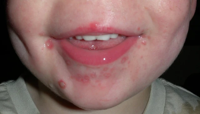 bai-viet/bi-tay-chan-mieng-boi-acyclovir-co-hieu-qua-cho-tre-nho.html