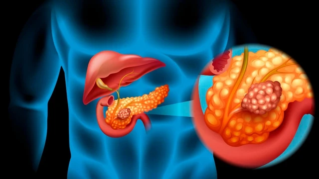 bai-viet/bi-ung-thu-tuyen-tuy-co-chua-duoc-khong-ung-thu-tuyen-tuy-song-duoc-bao-lau.html