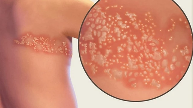 bai-viet/bien-chung-cua-benh-gioi-leo-de-doa-den-tinh-mang-nhu-the-nao.html