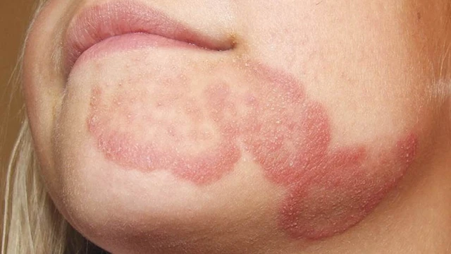 bai-viet/bien-chung-hac-lao-co-nguy-hiem-khong-54044.html