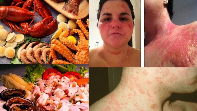 bai-viet/bien-chung-nguy-hiem-di-ung-hai-san-soc-phan-ve-61043.html