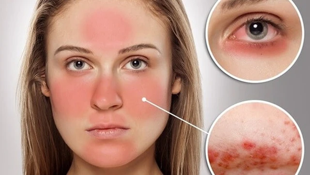 bai-viet/bien-chung-nguy-hiem-lupus-ban-do-bien-chung-huyet-hoc-59087.html