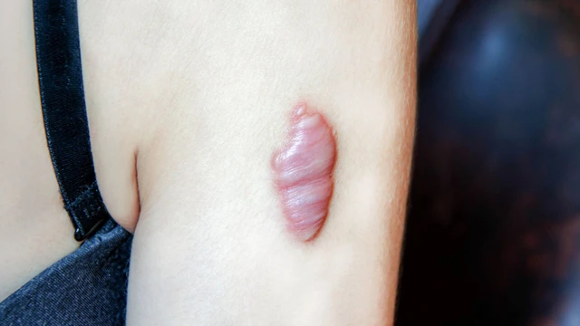 bai-viet/bien-chung-sau-khi-tiem-seo-loi-la-gi-cham-soc-seo-sau-khi-tiem-nhu-the-nao.html