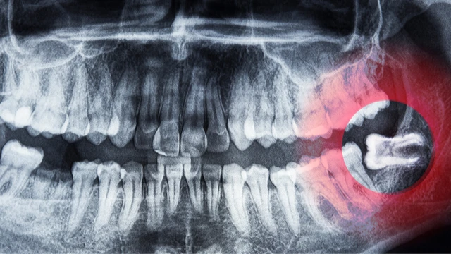 bai-viet/bien-chung-viem-loi-trum-do-rang-khon-la-gi-co-nguy-hiem-khong.html