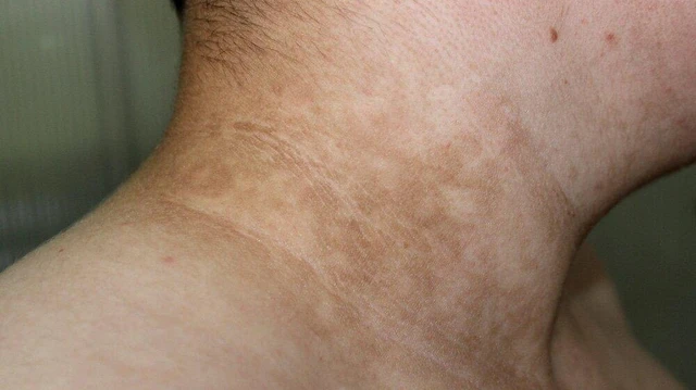 bai-viet/bieu-hien-cua-benh-gai-den-va-cach-dieu-tri.html