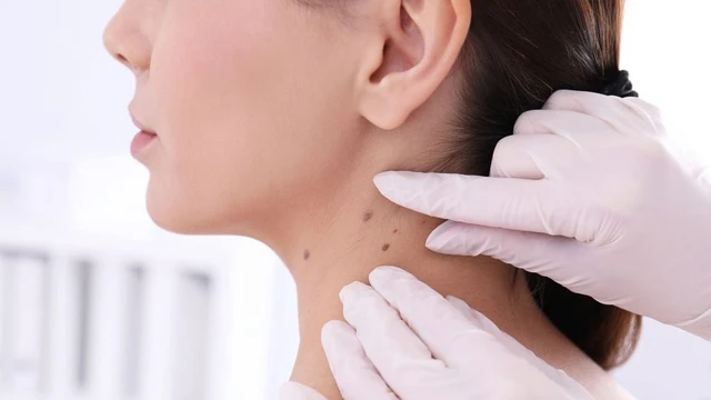 bai-viet/bieu-hien-cua-not-ruoi-khong-dien-hinh-nhu-the-nao.html