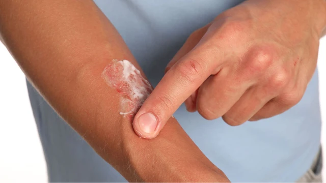 bai-viet/boi-kem-tri-seo-bao-lau-thi-khoi-huong-dan-boi-kem-chong-seo-hieu-qua.html